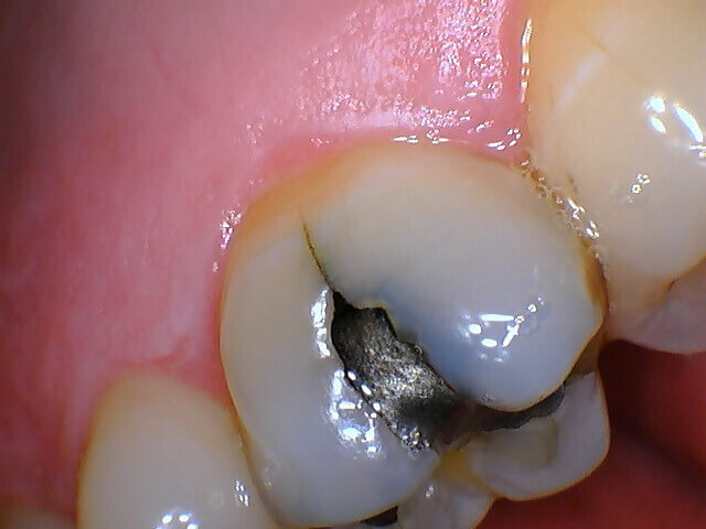 Intraoral image captured with MouthWatch intraoral cameras