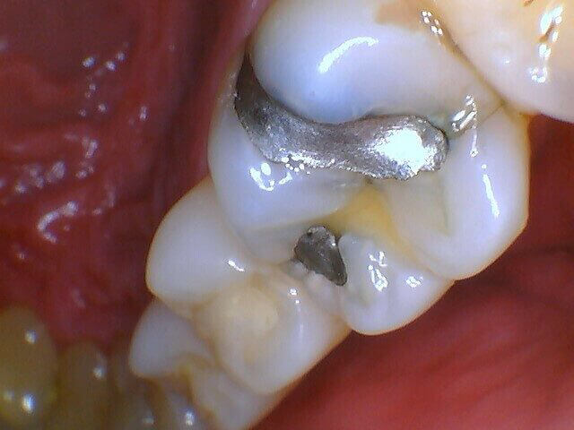 Intraoral image captured with MouthWatch intraoral cameras