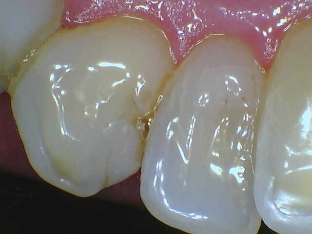 Intraoral Image