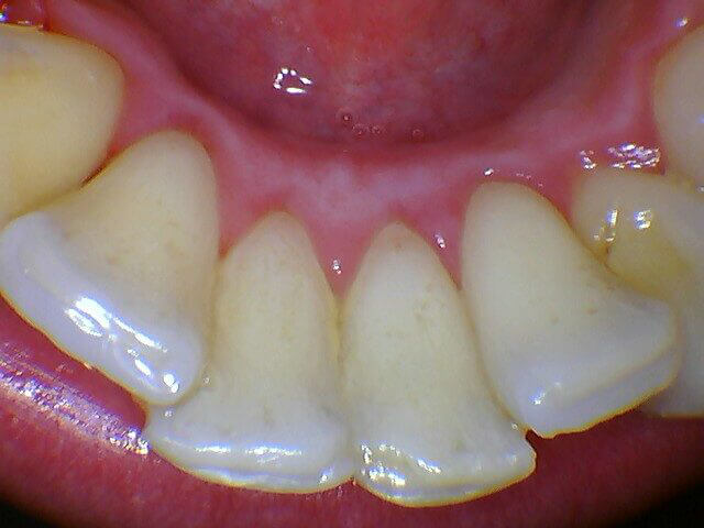 Intraoral image captured with MouthWatch intraoral cameras