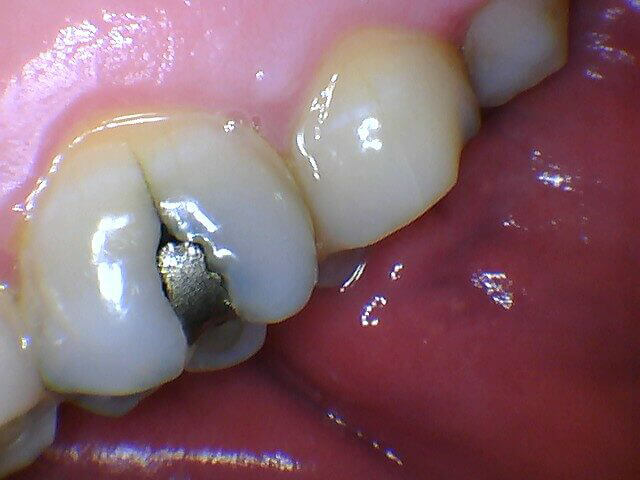 Intraoral image captured with MouthWatch intraoral cameras