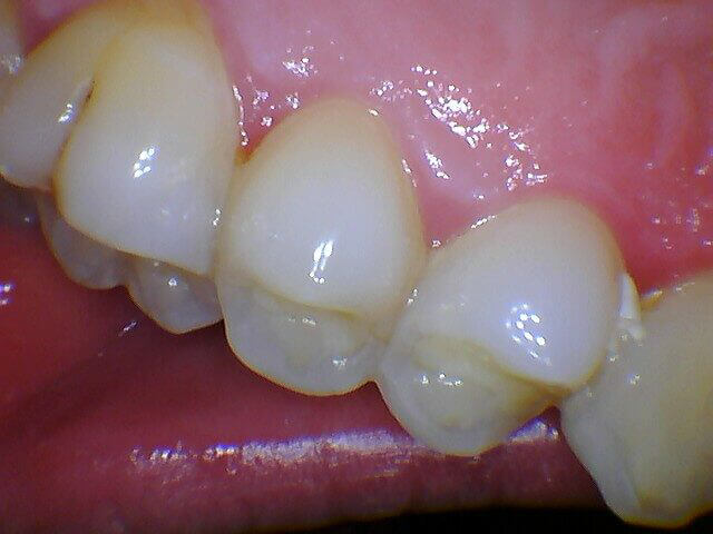 Intraoral image captured with MouthWatch intraoral cameras