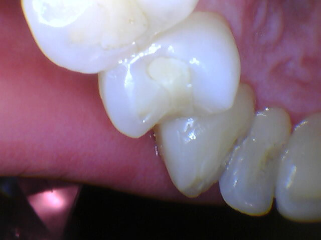 Intraoral image captured with MouthWatch intraoral cameras