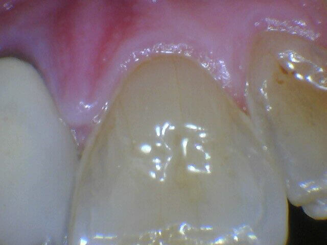 Intraoral image captured with MouthWatch intraoral cameras