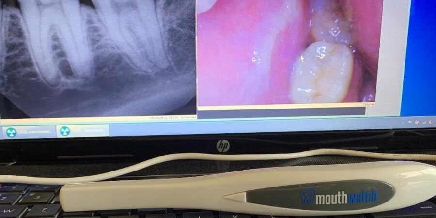 Experienced endodontist discusses his use of MouthWatch intraoral cameras